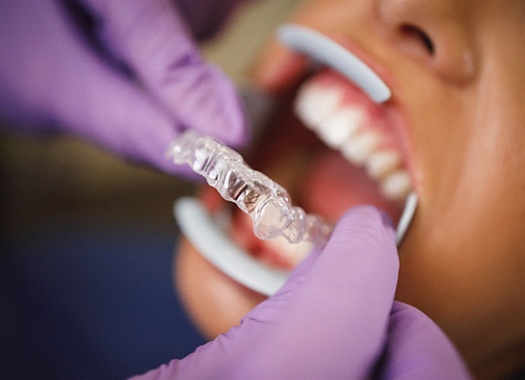 Dentist inserting Invisalign in Uptown New Orleans