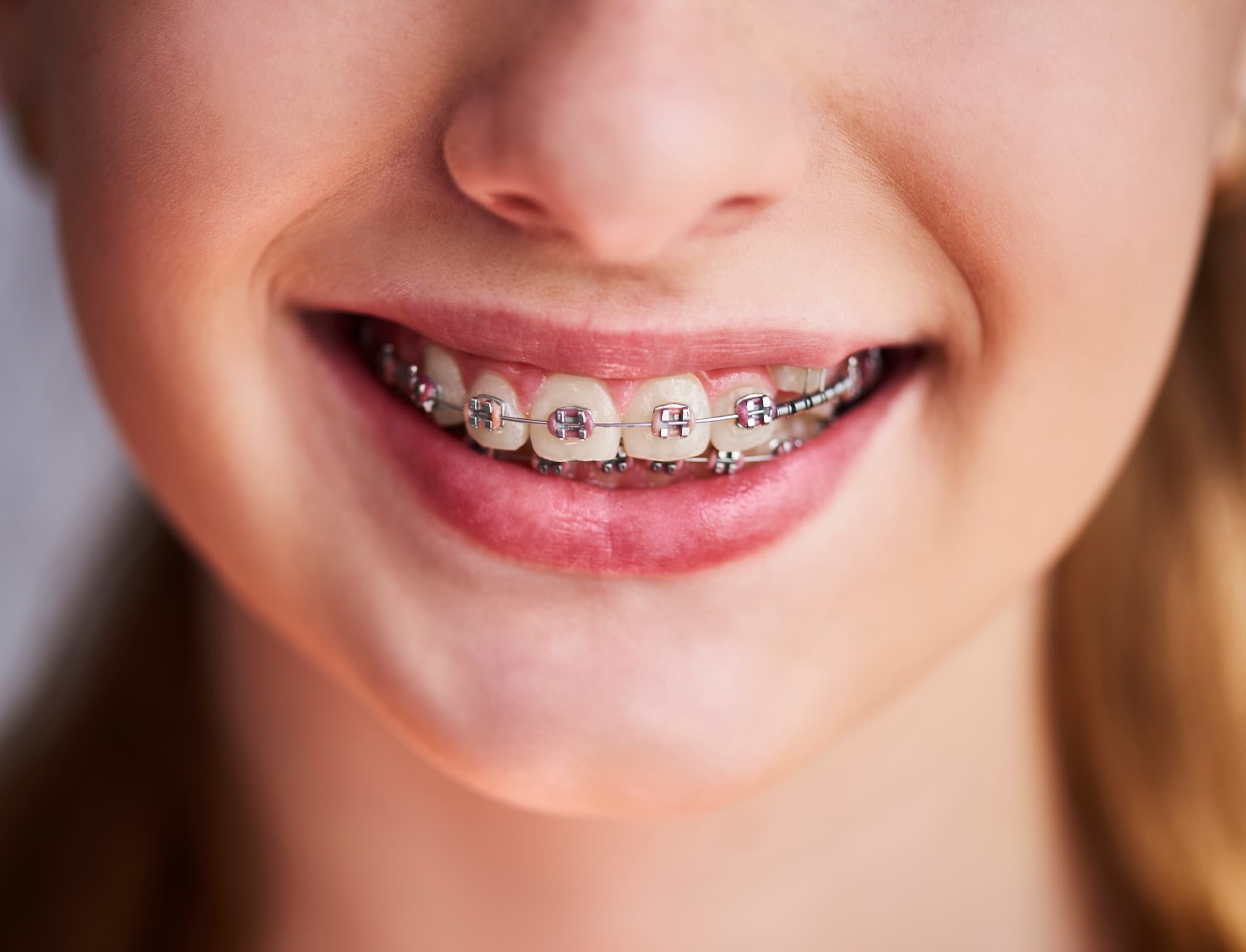 Modern low-profile braces on a relaxed, smiling patient