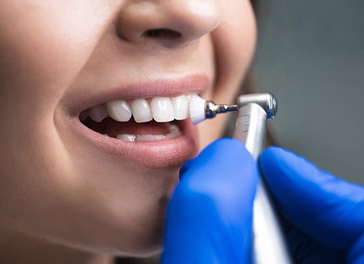 Dental Cleanings will polish and remove tartar from your teeth in New Orleans, LA