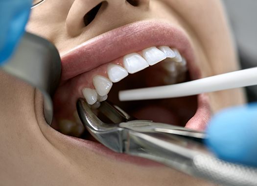 A woman having her tooth extracted with dental forceps