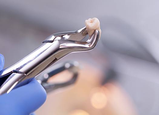 A dentist holding an extracted tooth with dental forceps