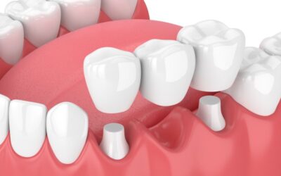 What Should You Do if Your Dental Bridge Falls Out?