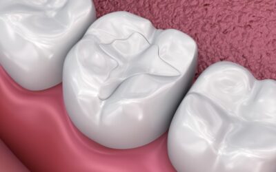How Should You Handle a Lost Dental Filling?