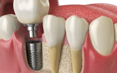 What’ll Happen When Removing a Failed Dental Implant