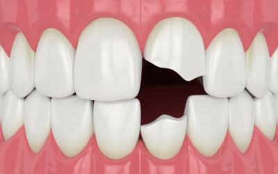 Do Chipped Teeth Heal Themselves?