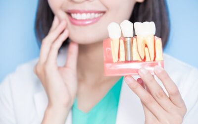 Top-Tier Dental Implants: What Makes Them Successful?