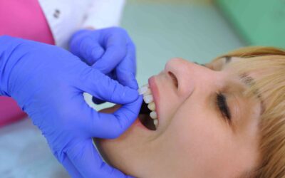 6 Reasons to Consider Getting Veneers