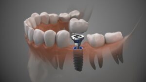 Animated set of dental implants.