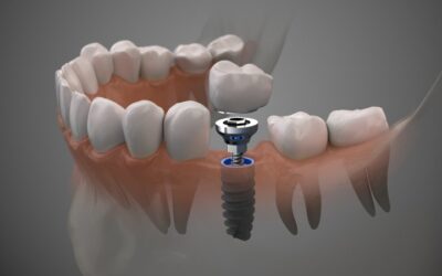 Missing in Action: Can Dental Implants Replace My Front Teeth?